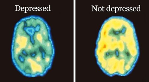 Depressed vs not depressed brain comparison