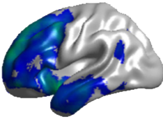 ALS patient with dementia showing areas of diminished blood flow