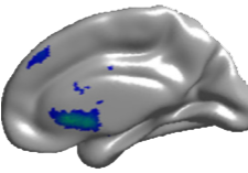 ALS patient without dementia showing less blood flow loss