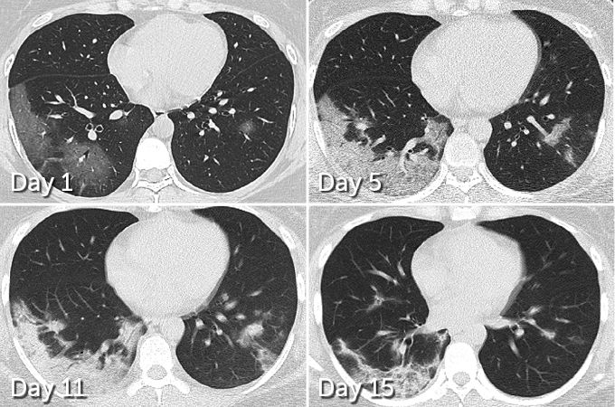 CT scan of the lungs of a woman through her COVID-19 infection and recovery