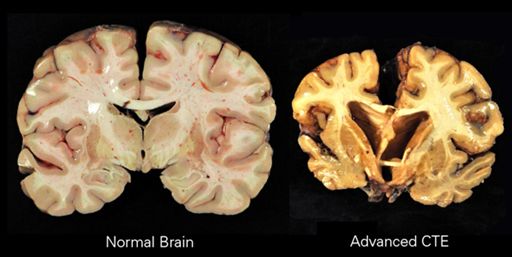 Comparison of healthy vs advanced CTE Brain