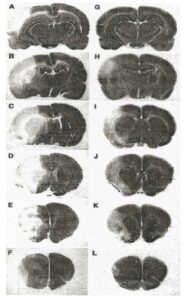 Effect of IV FGF-1 treatment in a focal animal model of acute stroke