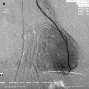 FGF-1 treated heart showing increased blood vessel growth