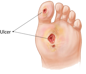 Foot Ulcer