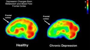 Functional MRI scan of a healthy brain and a brain from a patient with chronic depression