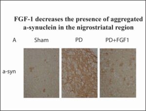 Parkinson's Disease nigrostriatal area with FGF-1 treatment