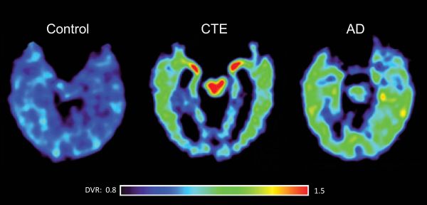 PET scan with the tau-specific tracer, FDDNP differentiates between CTE and Alzheimer's disease