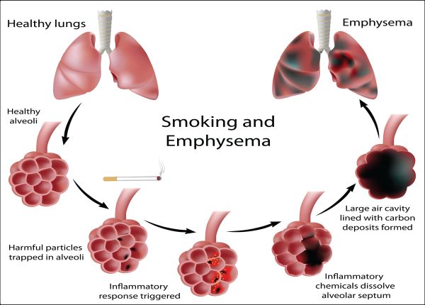 Smoking damages lung alveoli and leads to emphysema
