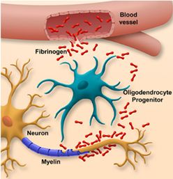 Fibrinogen leaking into the brain where the blood-brain barrier has broken down